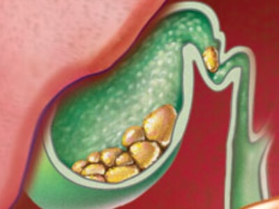 Gallstones