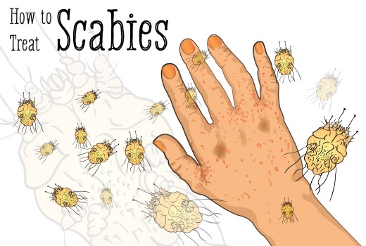 Scabicide